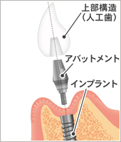 インプラント