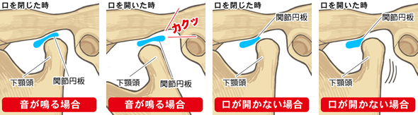 音がなる・口が開かない場合